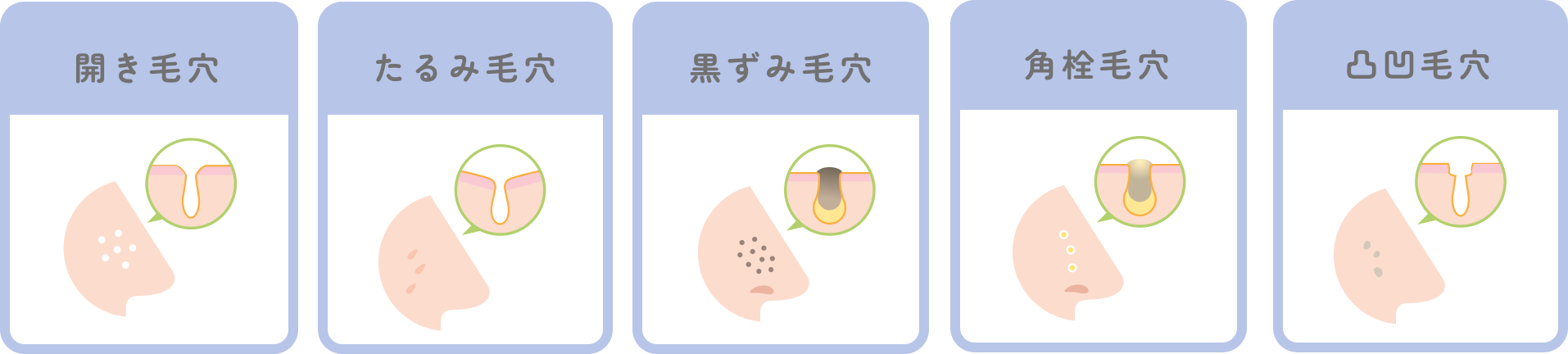 開き毛穴、たるみ毛穴、黒ずみ毛穴、角栓毛穴、凹凸毛穴のイラスト