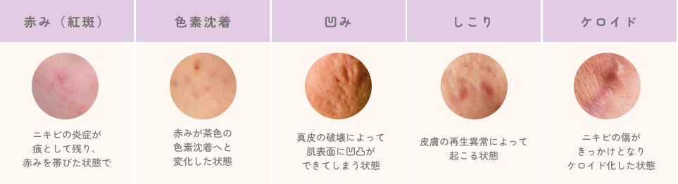 ニキビ痕の種類