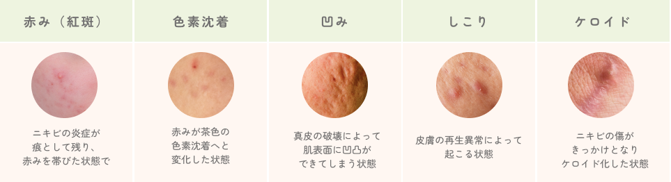 ニキビ痕の種類