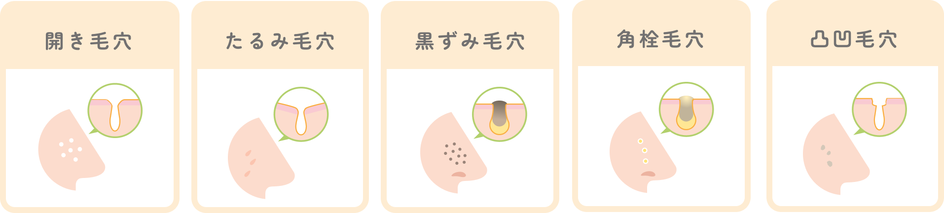 開き毛穴、たるみ毛穴、黒ずみ毛穴、角栓毛穴、凹凸毛穴のイラスト