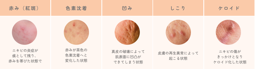 ニキビ痕の種類