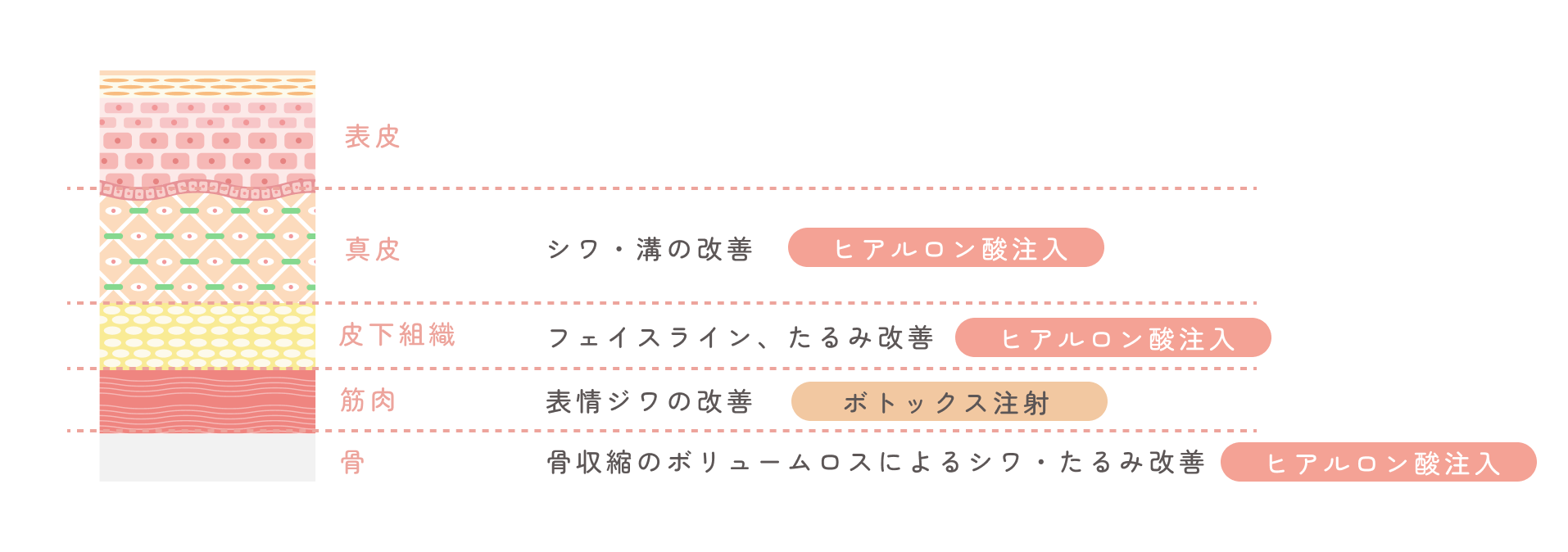 顔の層に応じた治療の説明図