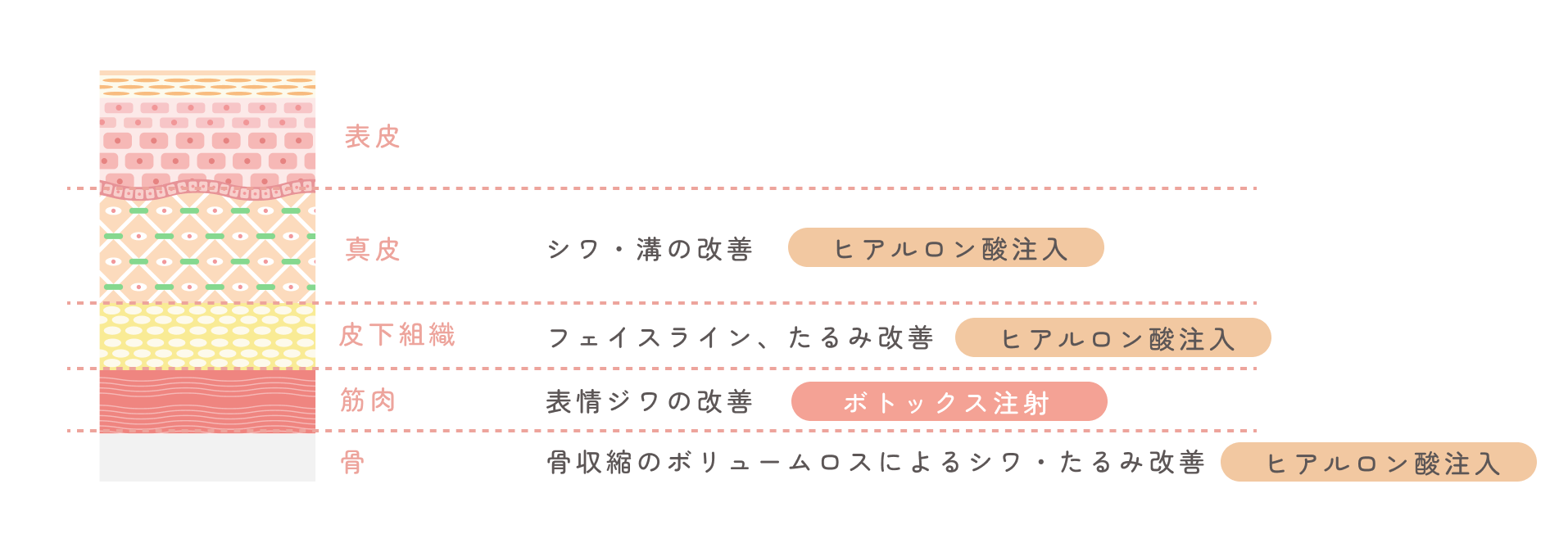 顔の層に応じた治療の説明図