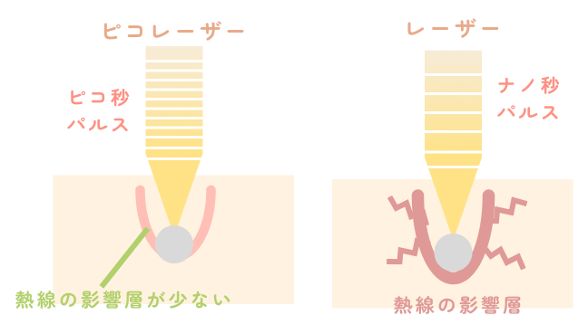 ピコレーザーはレーザーよりも肌に与える熱線の影響層が少ない