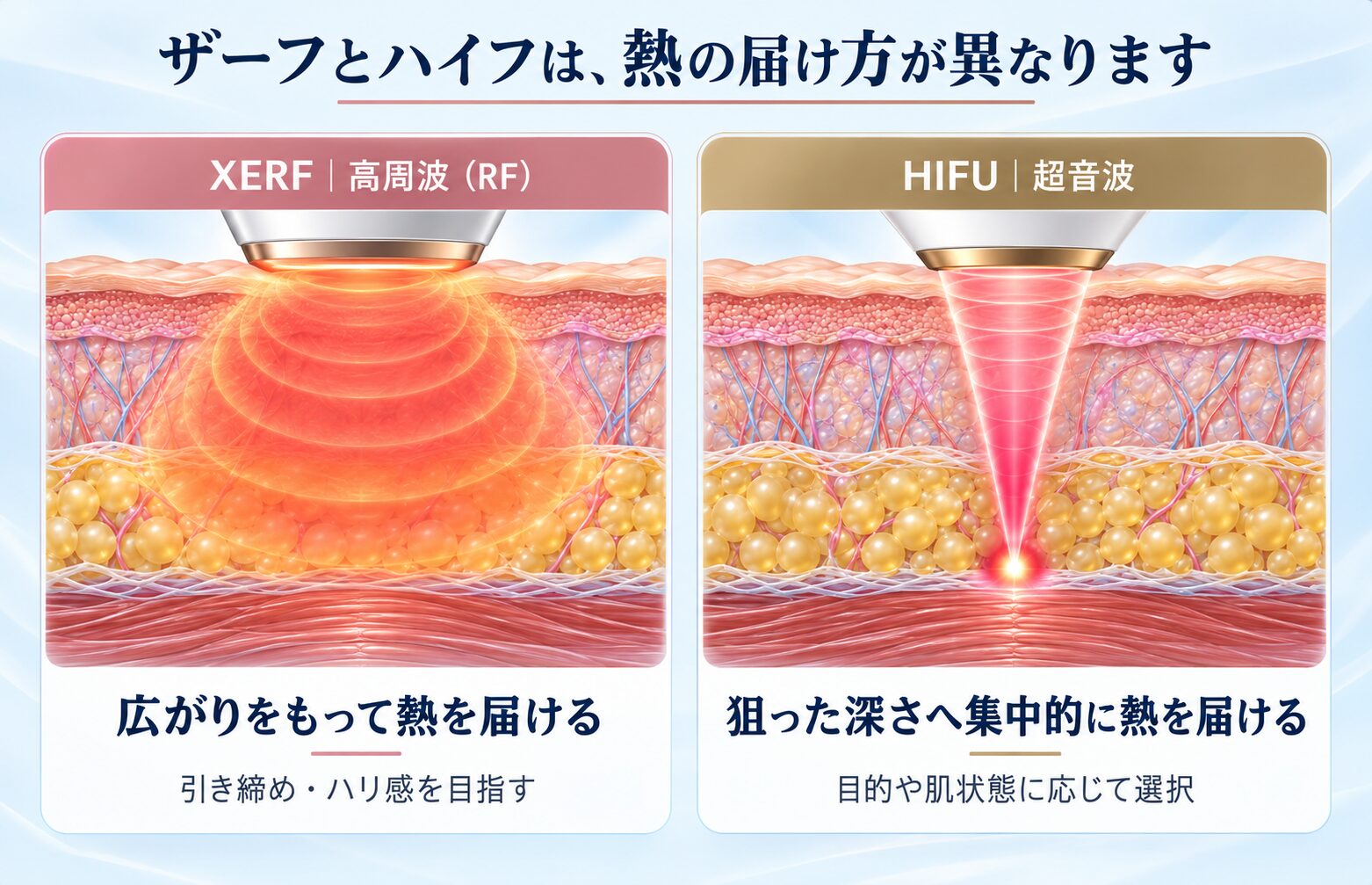 ザーフとハイフの熱の届き方の比較イメージ