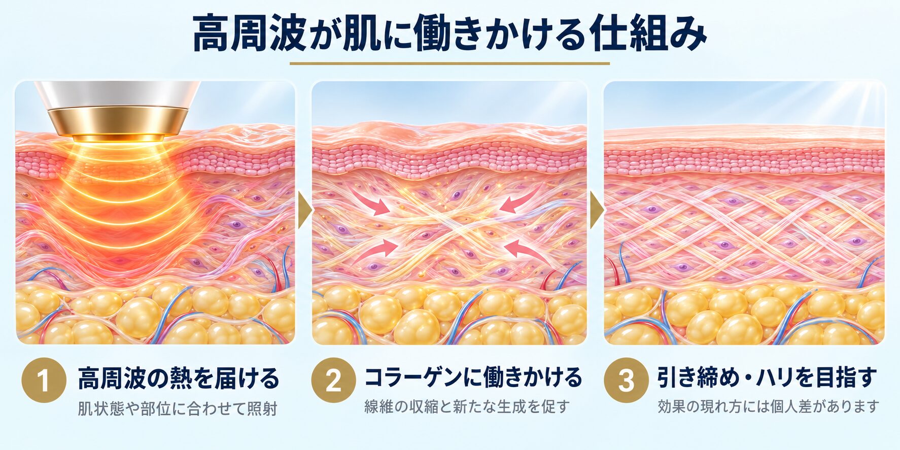 ザーフが肌へ働きかける仕組み。高周波の熱を届け、コラーゲンに働きかけ、引き締めとハリを目指す図