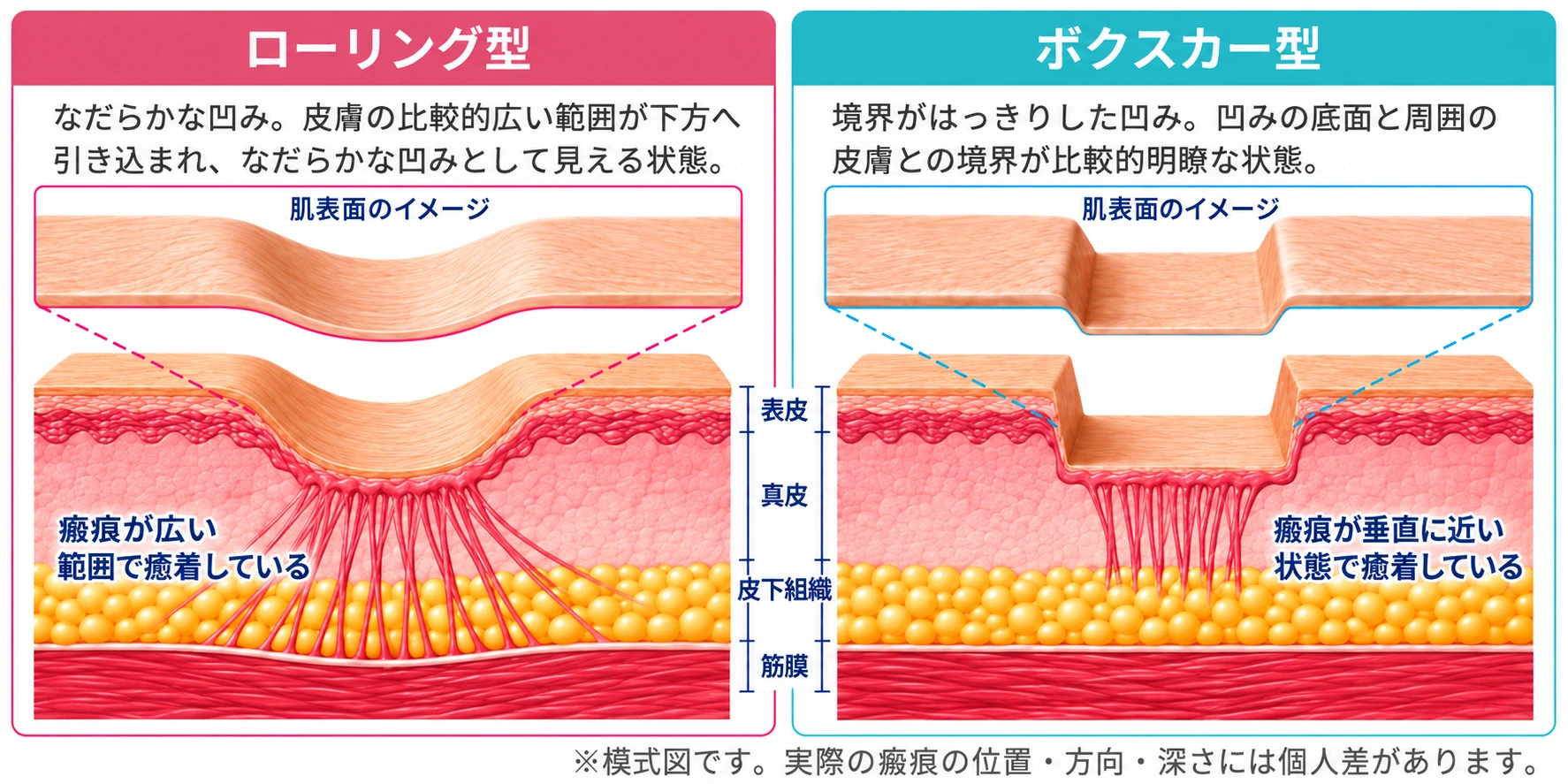 ローリング型を示す皮膚断面の模式図