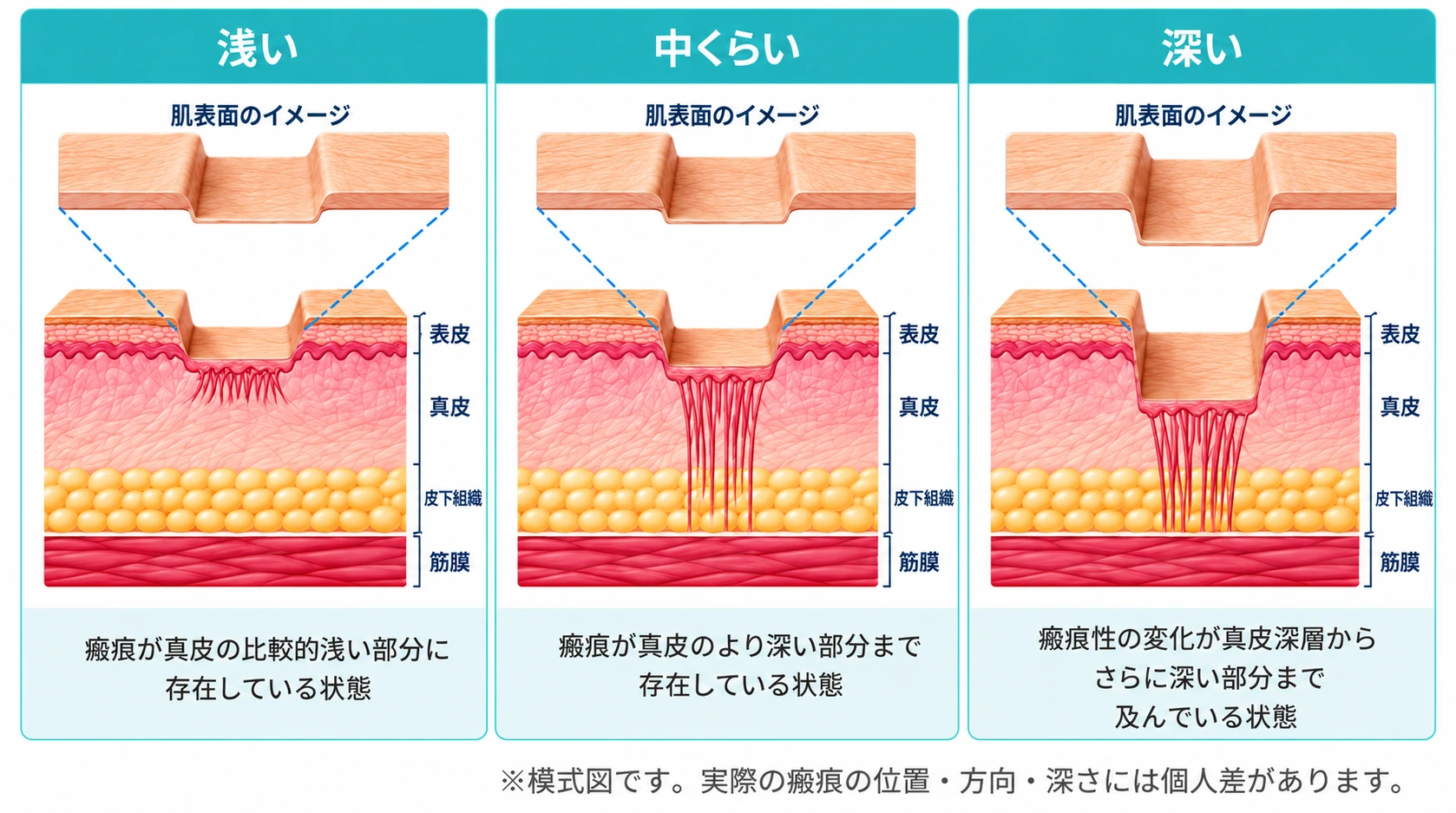 浅い瘢痕を示す皮膚断面の模式図