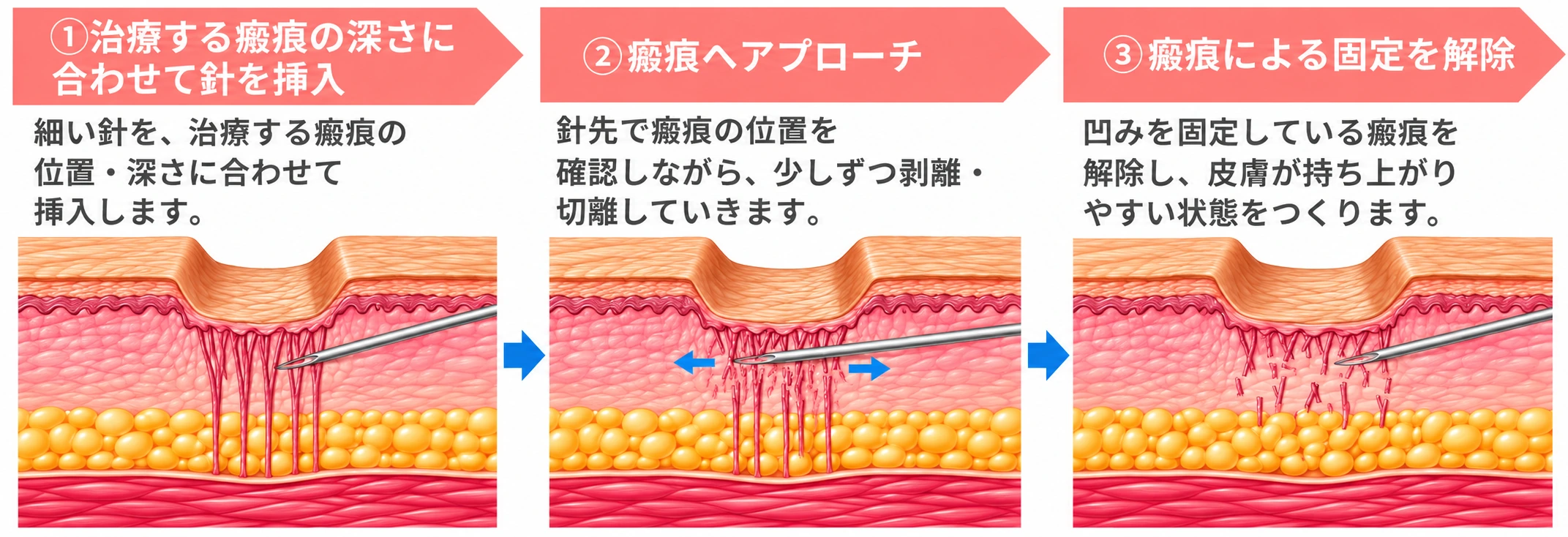 瘢痕の深さに合わせて針を挿入する様子を示す皮膚断面の模式図