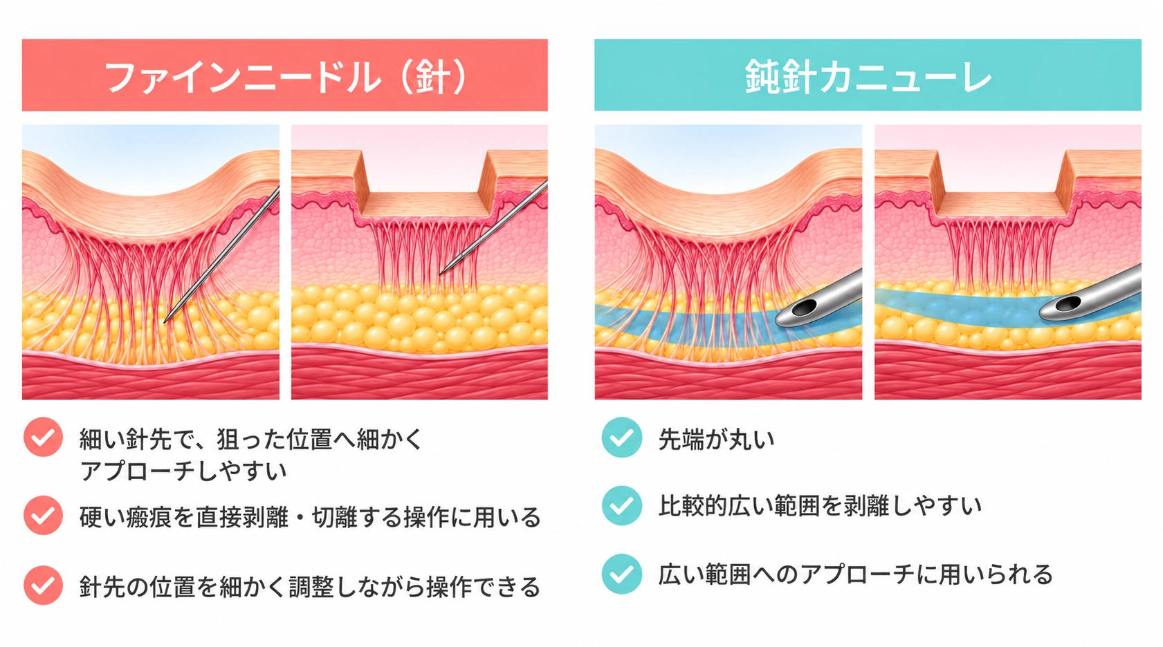 ファインニードル（針）を示す皮膚断面の模式図