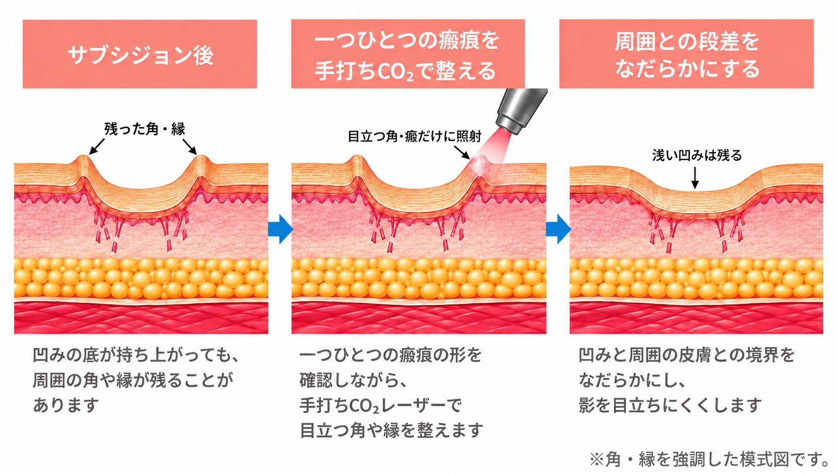 サブシジョン後を示す皮膚断面の模式図