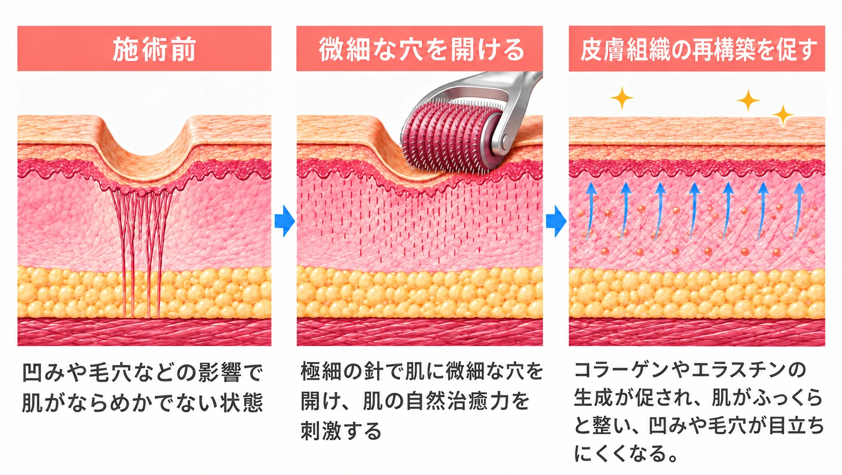 施術前を示す皮膚断面の模式図