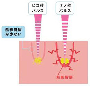 奈良のピコレーザーのシミ治療は皮膚科専門医のえいご皮フ科