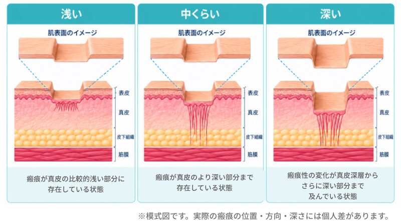 ボクスカー型の瘢痕の深さの模式図