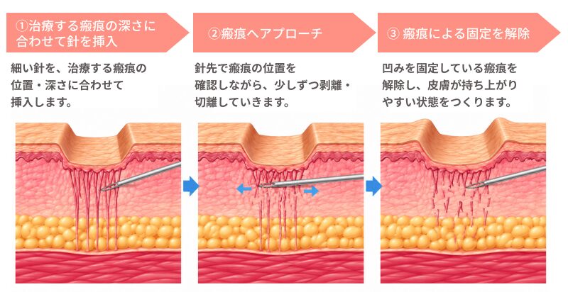 ファインニードルを用いたサブシジョン