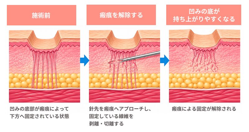 サブシジョンで瘢痕による固定を解除
