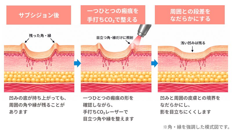 手打ちCO₂アブレージョンで、残った凹みの縁を整える