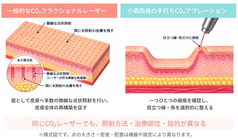 一般的なCO₂フラクショナルレーザーと小森院長の手打ちCO2アブレーションの違い