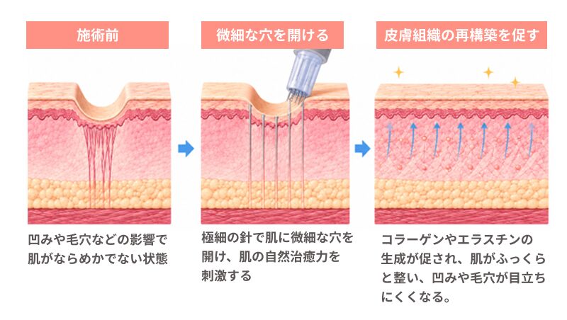 ニードリングによる創傷治癒反応を利用した皮膚の再構築
